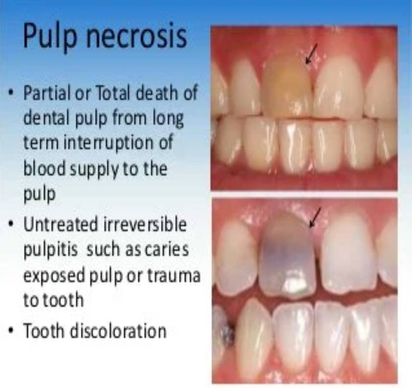 مقاله علمية لرئيس قسم طب الأسنان أ.د عذراء يحيى محمد الحجازي بعنوان Pulp Necrosis