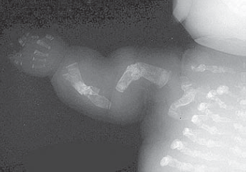 Osteogenesis imperfecta (OI)
