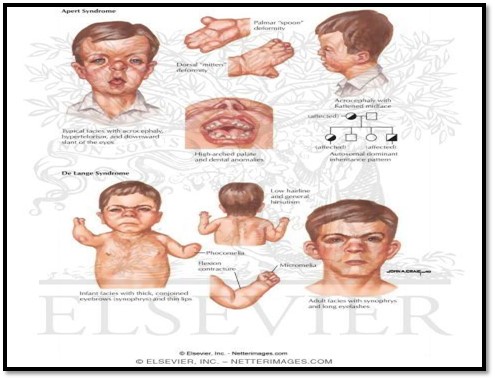 ?What is Alport syndrome