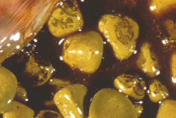 Bile salt deficiency: cholelithiasis