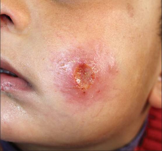 مقاله بعنوان داء الليشمانيا الجلدية ( حبة بغداد)