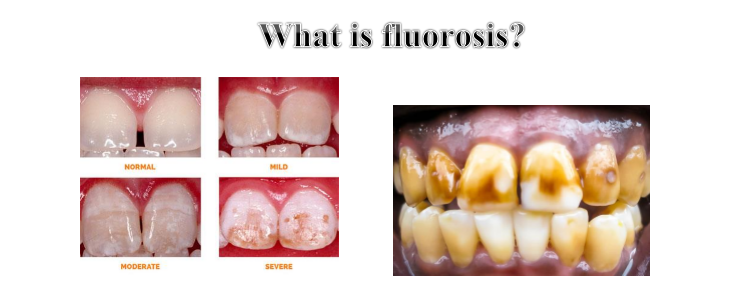 A new scientific article by Dr. Duha Malik Hassan entitled what is Fluoride 
