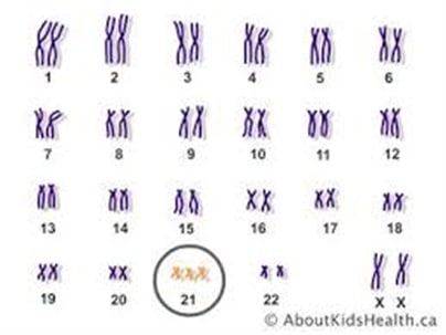 Down Syndrome متلازمة داون م.م دعاء عادل