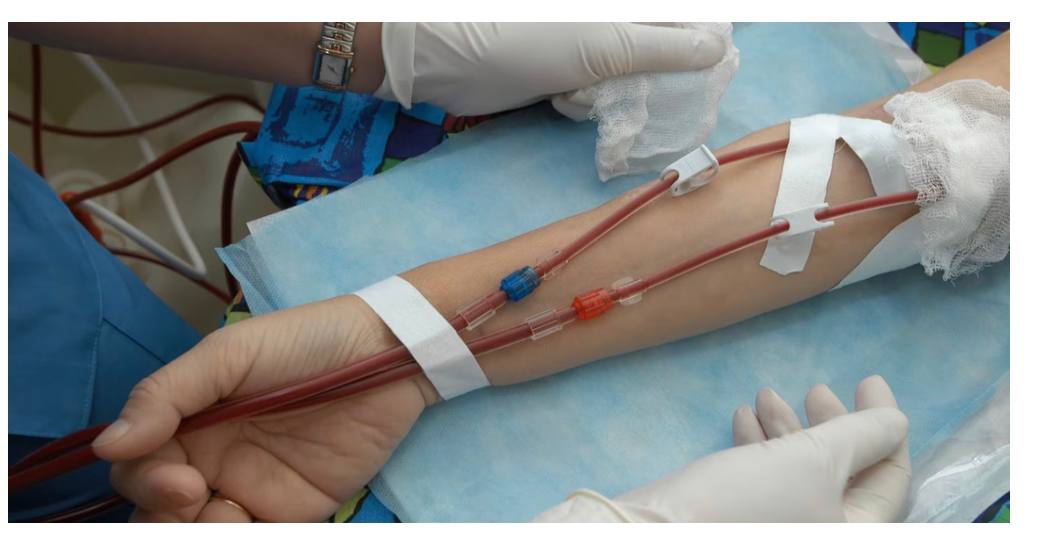 حلقة نقاشية" غسيل الكلى عن طريق الدمKidney Dialysis"