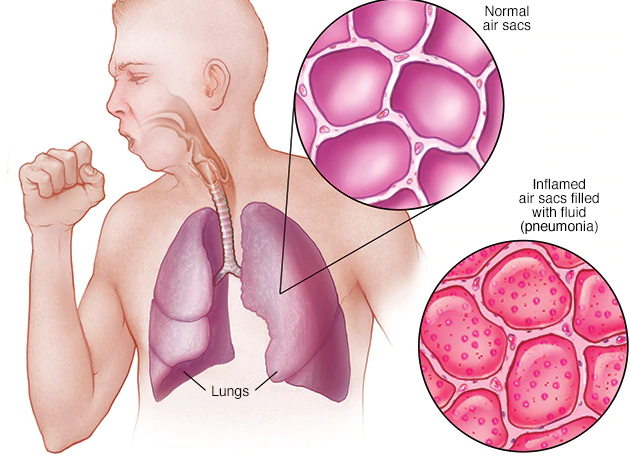 Pneumonia