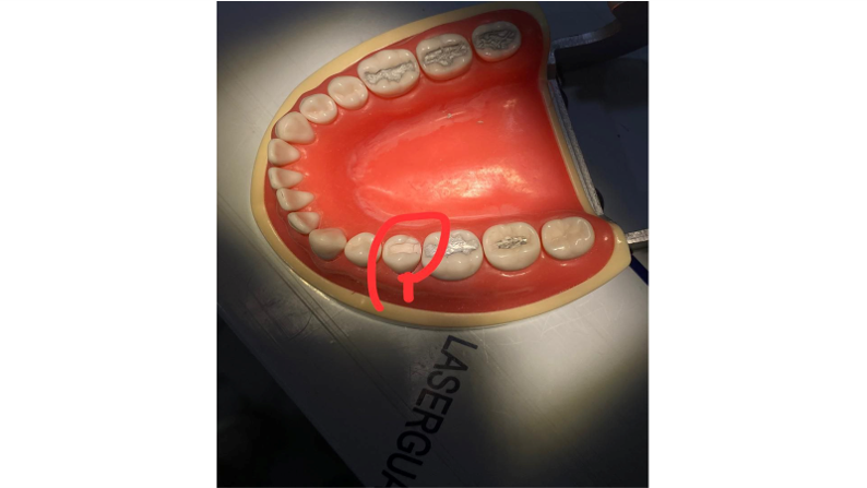 أبداع طالبة من المرحلة الثالثة في عمل حشوة في مختبر الطالب 