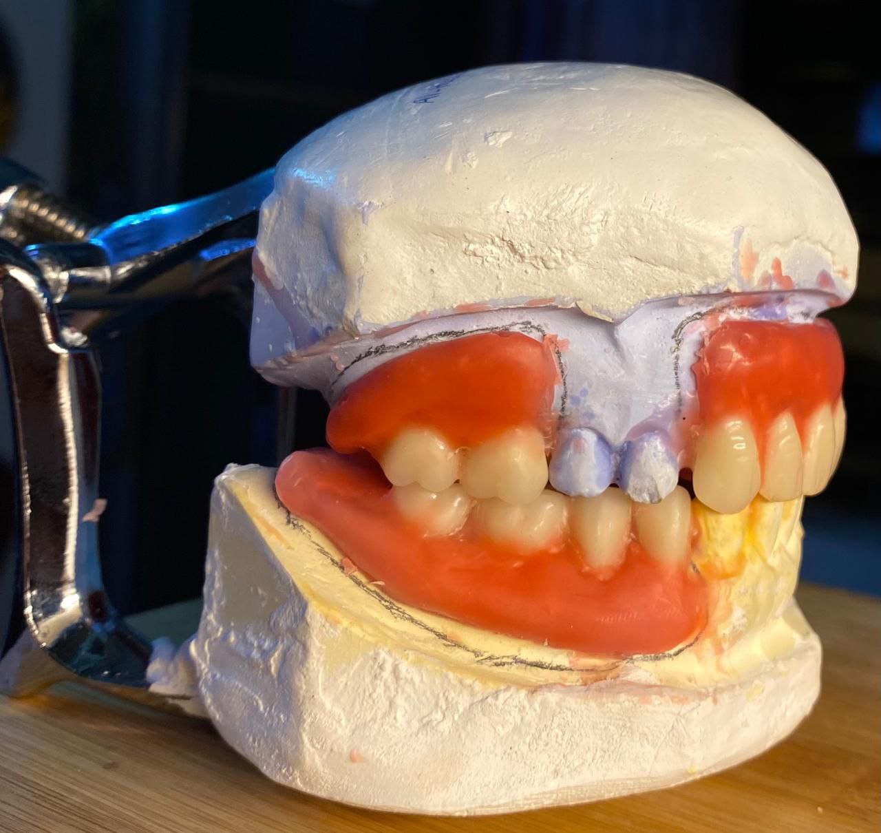 أبداع احد طلبة المرحلة الثالثة في عمل جسر جزئي متحرك في مختبر  صناعة الاسنان 