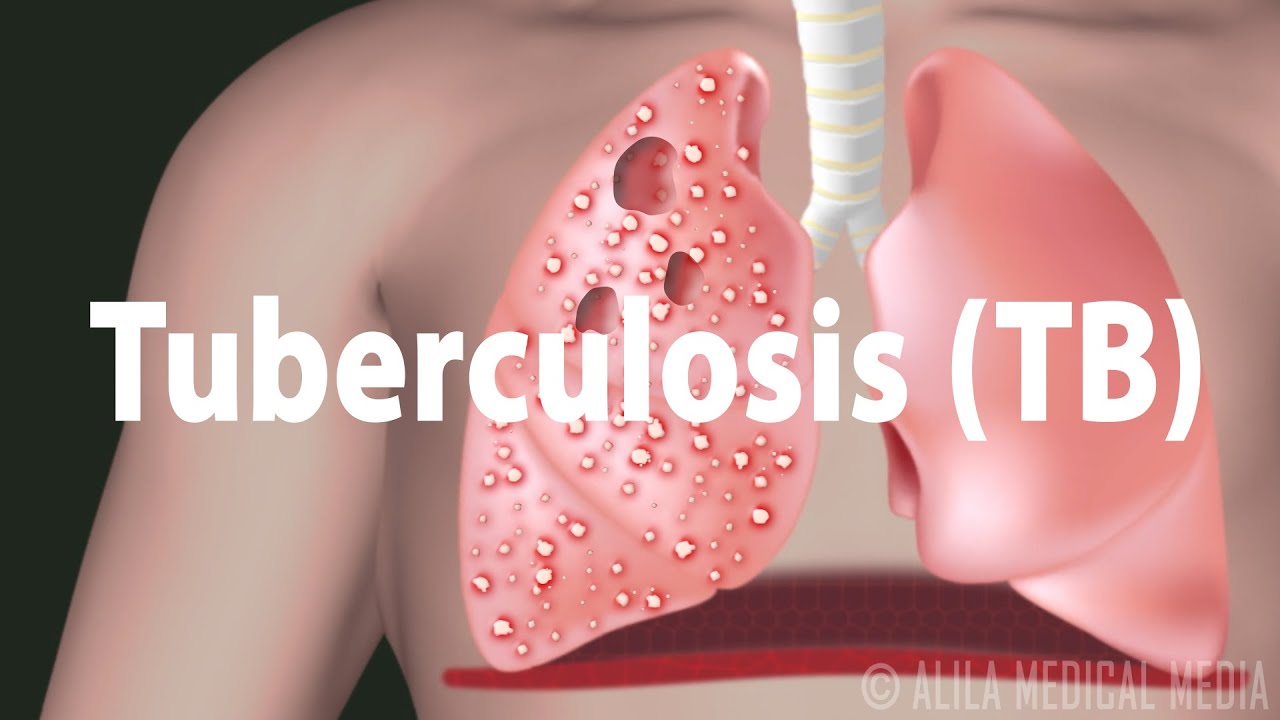 Tuberculosis (TB)