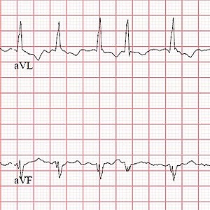 Atrial fibrillation