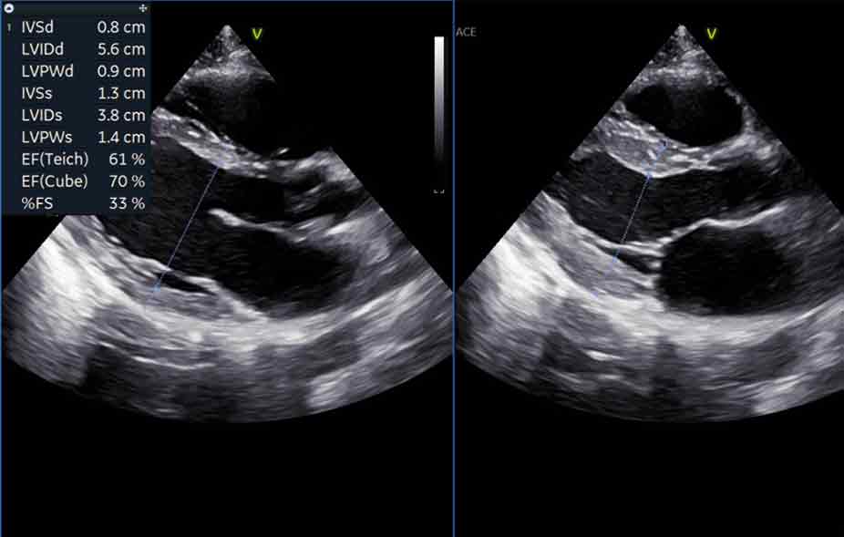  Cardiac output and Ejection fraction 