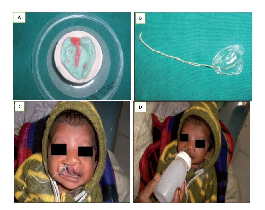feeding-plate-for-cleft-lip-and-palate-baby