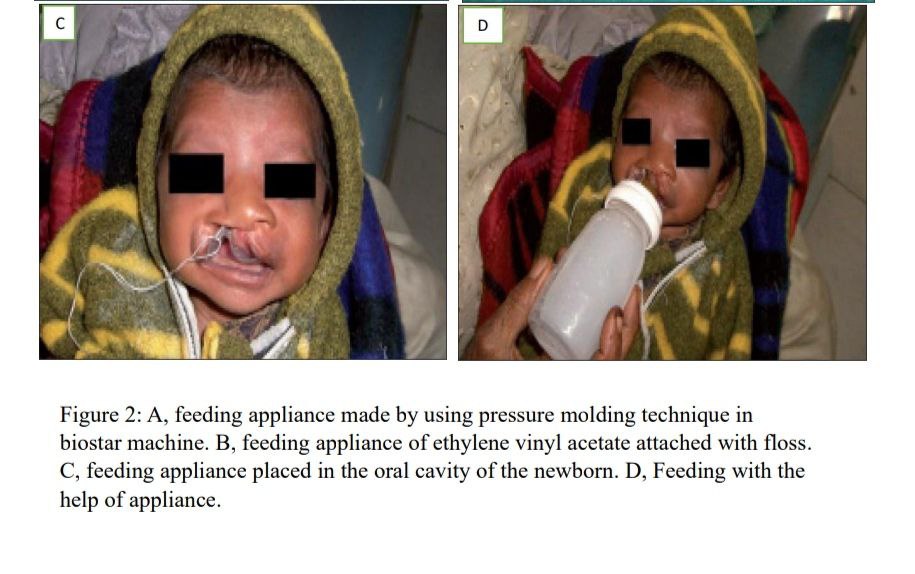 Feeding plate for cleft lip and palate baby