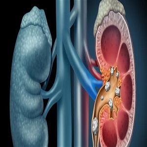 زيادة نسبة الكرياتينين 