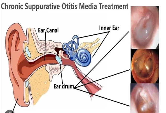 A scientific article for Dr. Ali Hussein Hamzah Al-Nasrawi entitled (Chronic Suppurative Otitis Media Otoscopy as an Alternative to Microscope for Diagnosis)