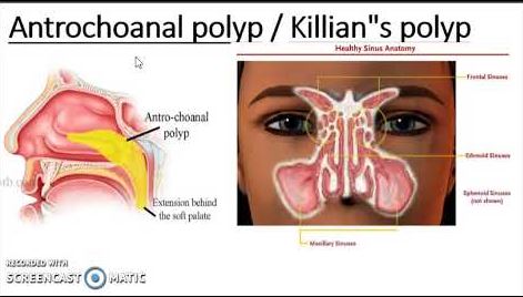 A scientific article for Dr. Ali Hussein Hamzah Al-Nasrawi entitled (Antrochoanal Polyps)