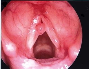A scientific article for Dr. Ali Hussein Hamzah Al-Nasrawi entitled (Laryngeal Polyps and Nodules)