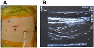 The efficacy of ultrasound guided transversus abdominis plane (TAP) block vs. local wound infiltration for post-operative analgesia after cesarean section under general anesthesia: A randomized controlled double-blinded clinical trial