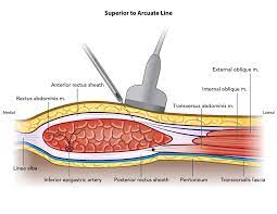 Research on the efficacy of the rectus sheath block method
