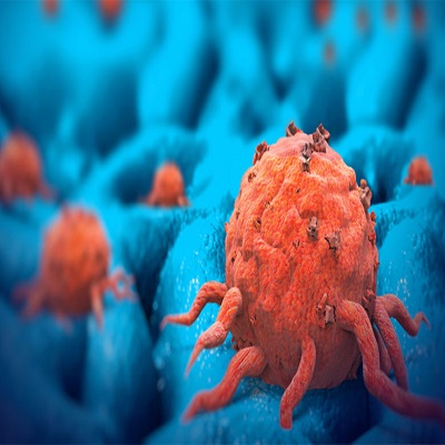 رهاب السرطان".. لماذا يخاف الناس من المرض الخبيث أكثر من غيره؟