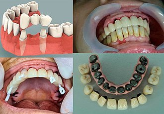 حلقة نقاشية"Dental prosthesis"