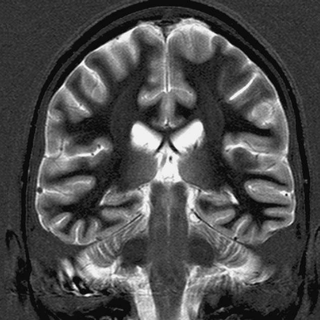 The recommended dosage of gadolinium