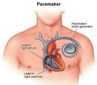حلقة نقاشية " عملية زراعة جهاز تنظيم ضربات القلب"