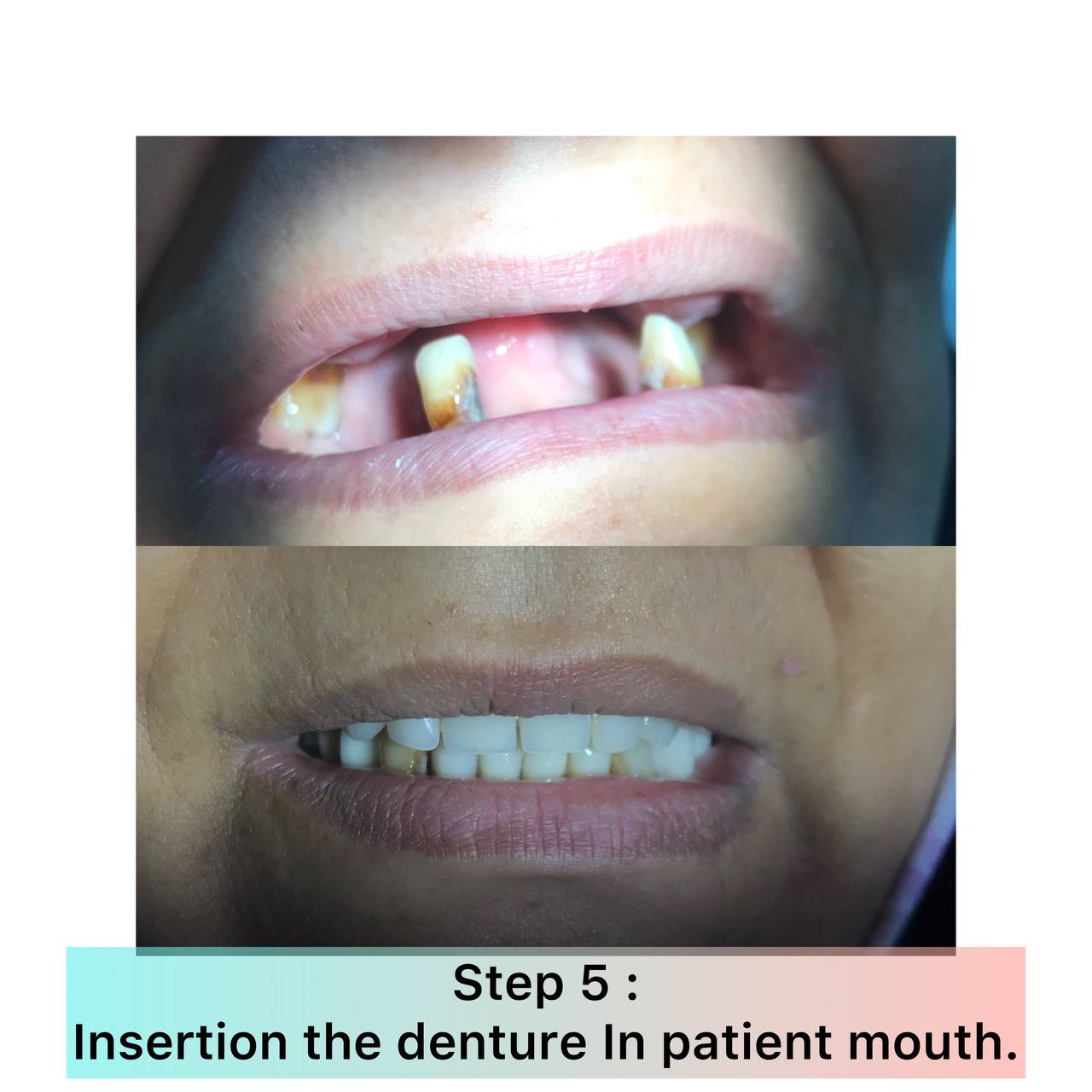 تميز وابداع طالبة في عمل طقم أسنان كامل لمريض في عيادة صناعة الأسنان 