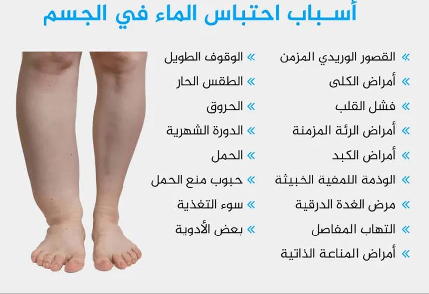 مقالة علمية للتدريسية م.م وفاء حفظي بعنوان ( احتباس السوائل في الجسم أو الاستسقاء)