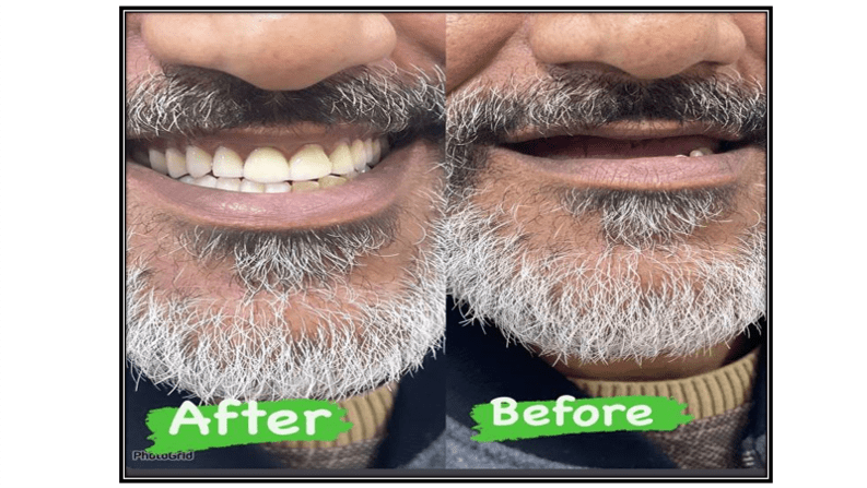 أبداع طالبة في عمل طقم أسنان في عيادة صناعة الأسنان 