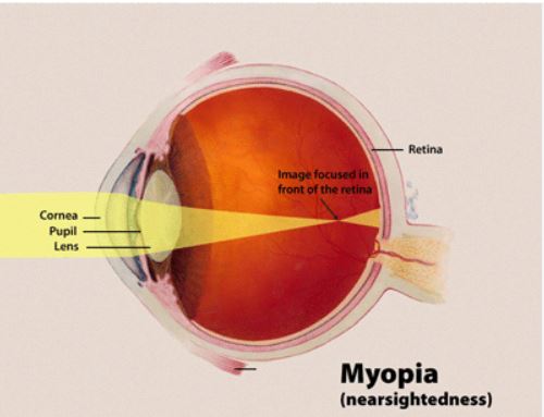 A scientific article by the lecturer Ali Hadi Maidi entitled (myopia)