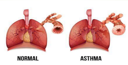 ورشة عمل بعنوان "Asthma"