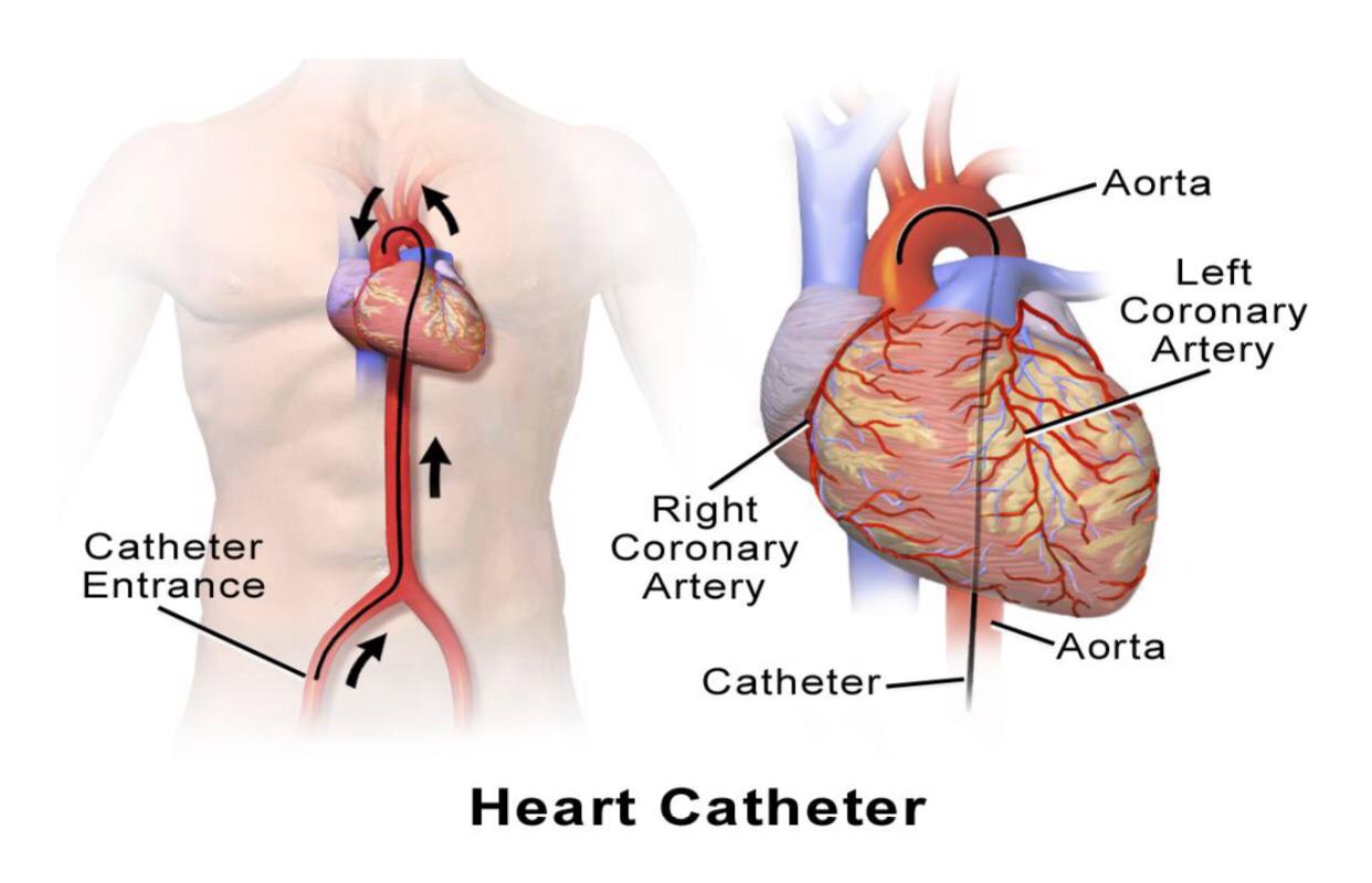 حلقة نقاشية بعنوان "القسطرة القلبية(Heart Catheter )"