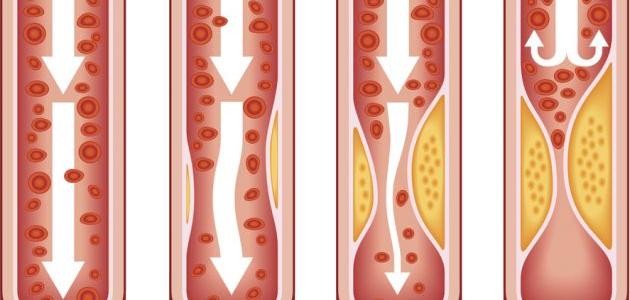 حلقة نقاشية"تصلب الشرايين"