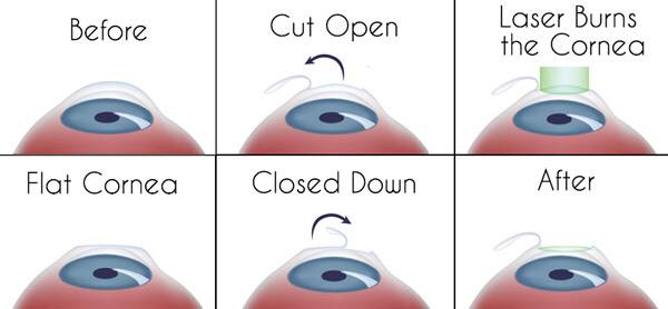 حلقة نقاشية بعنوان " جراحة العين بتقنية الليزر (LASIK)"