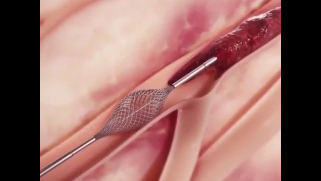 حلقة نقاشية بعنوان "جهاز استئصال الخثرة"