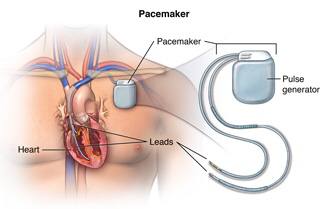 حلقة نقاشية " PACEMAKERS"
