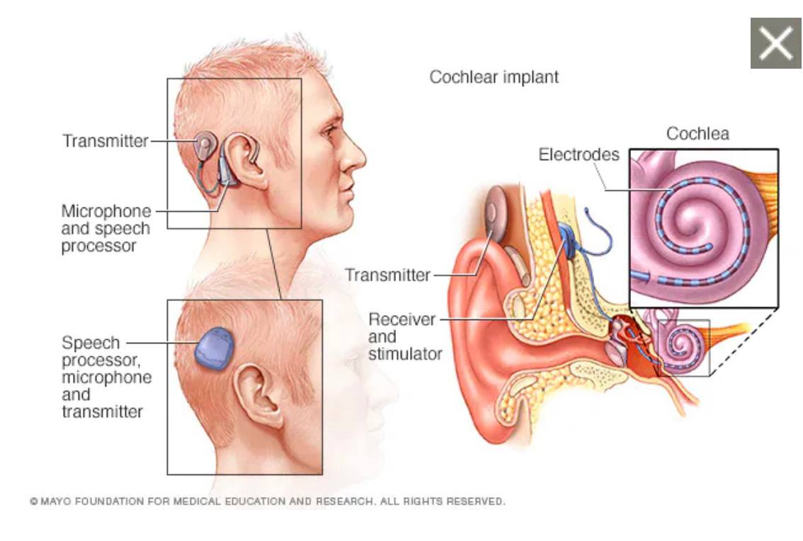 حلقة نقاشية بعنوان"الغرسة القوقعية"