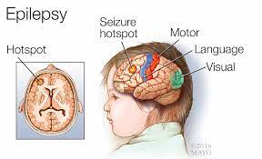 A scientific workshop by Teaching Assistant Tamara Nihad Abbas entitled (Epilepsy)