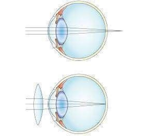 مقالة علمية للتدريسي م.م مهيمن سمر عارف بعنوان (طول النظر : Hypermetropia)