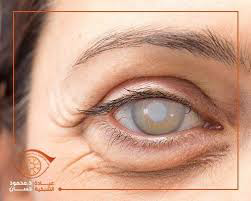 مقالة علمية للمعيدة الست حوراء صادق هاتف بعنوان ( الماء الأبيض ) 