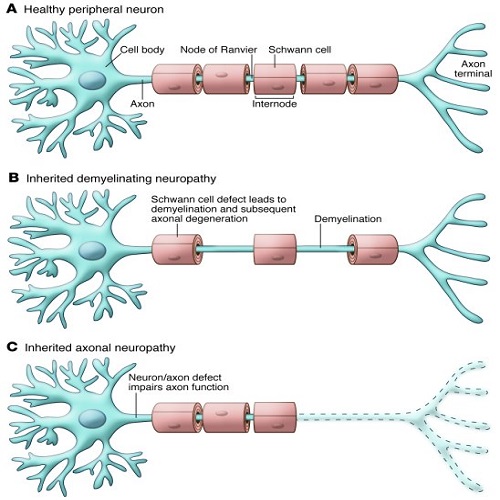 Peripheral Polyneuropathy