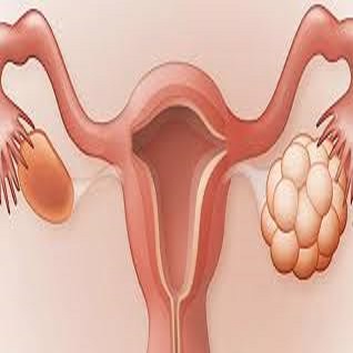 العقم وتأخر الإنجاب في متلازمة تكيس المبايض