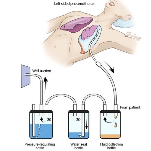 Chest tube