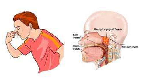 Scientific article by Dr. Ali Hussein Hamza Al-Nasrawi Otorhinolaryngologist and laser specialist  entitled (Jovenil Nasufaringial Angiovibroma) 