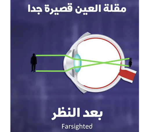 مقالة علمية للتدريسي م.م. علي هادي معيدي بعنوان (بعد البصر : تقيمه وادارته ومضاعفاته)