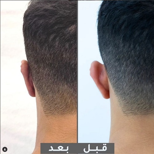 Otoplasty: Reshaping Your Ears for a More Balanced Look