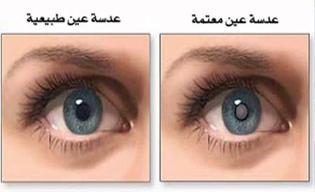 مقالة علمية للتدريسي الدكتور غيث علي محمود بعنوان (الساد الماء الابيض).