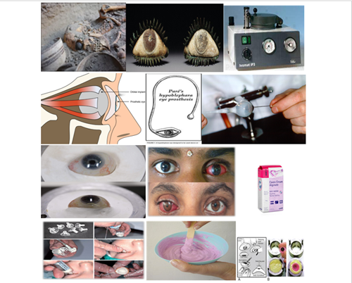 Scientific article by M.Sc. Marrwan Hisham Mohammed entitled (The history of ocular prostheses and how they are made?) 