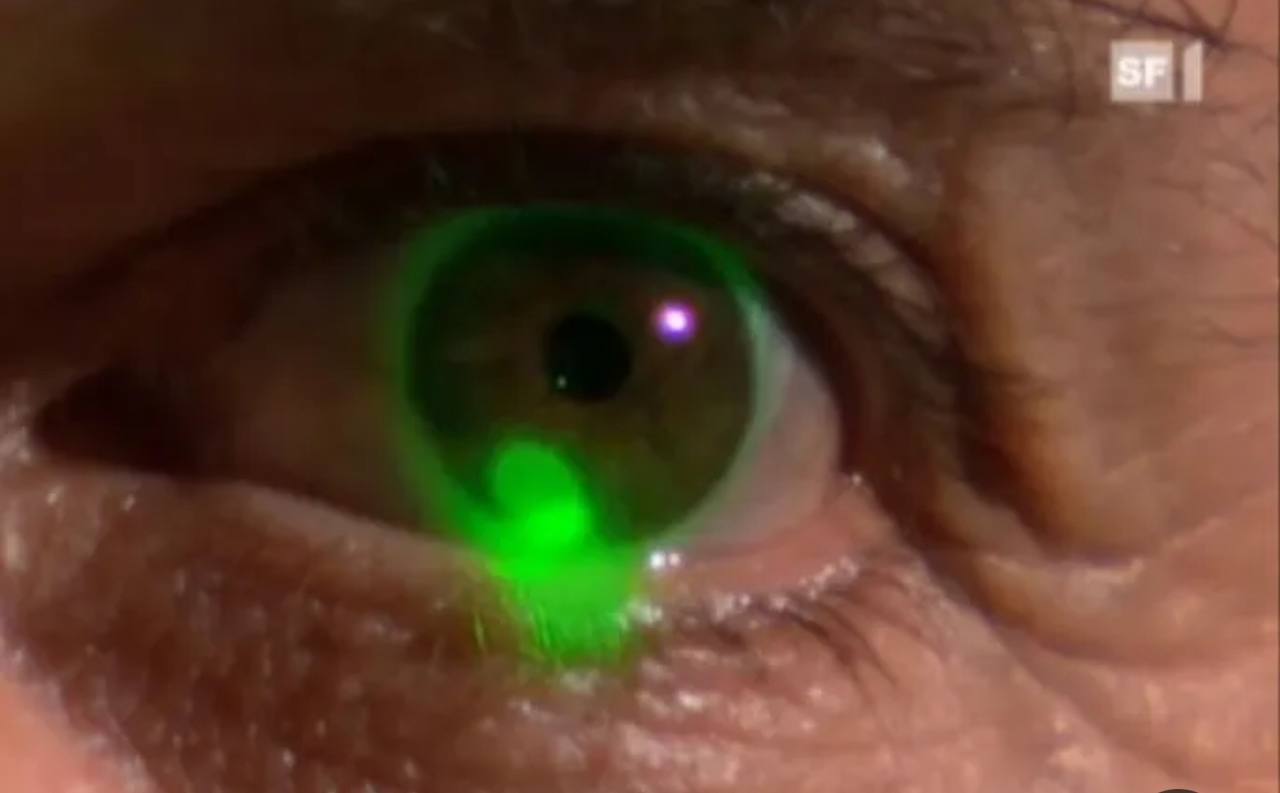 مقالة علمية للمعيدة تمارا نهاد عباس بعنوان(تاثير ليزر الكاربون على العين)