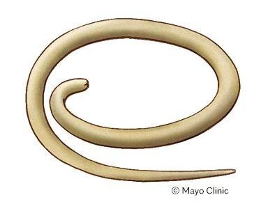 التهاب الدودة الدبوسية 